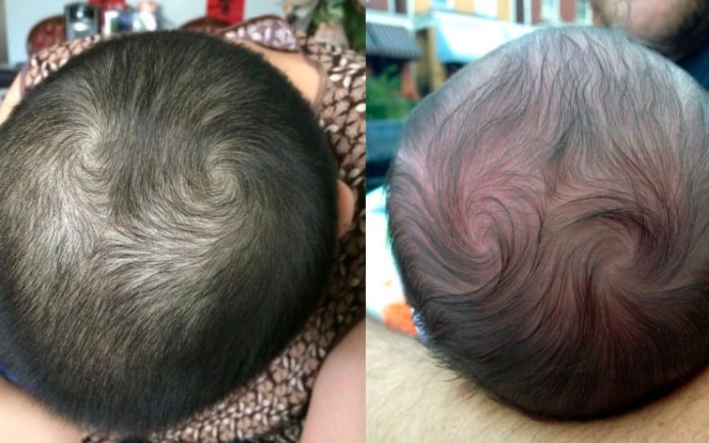 Khoa học hiện đại về vòng xoáy tóc